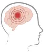 Meningitis