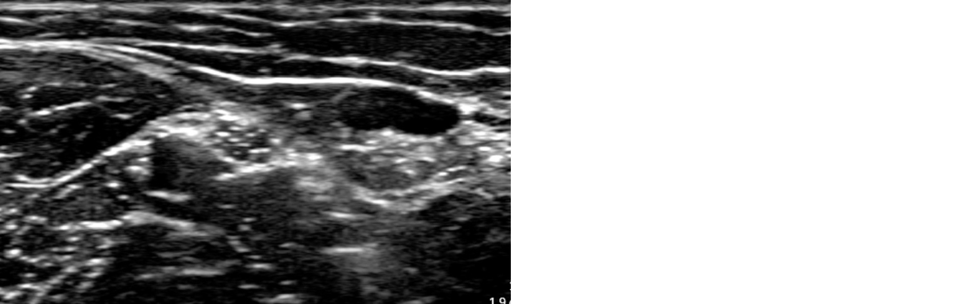 Ultrasound image of the median nerve superior to the elbow crease in the upper limb 