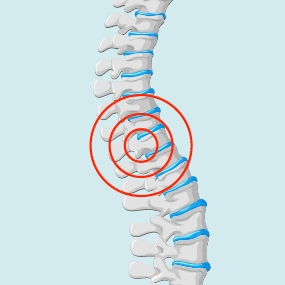 Nerve damage associated with a spinal or epidural injection icon